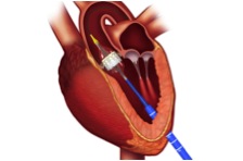 Innovative Heart Surgery