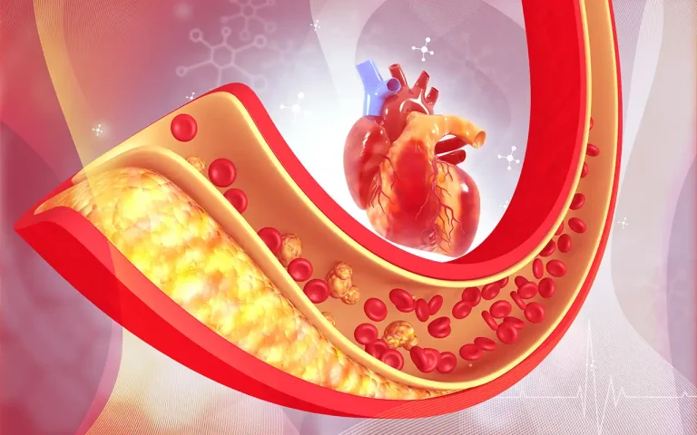 Illustration of plaque build-up in the coronary arteries - the most common cause of heart failure