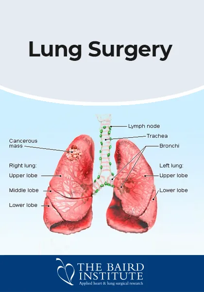 Fact Sheet - Lung Surgery